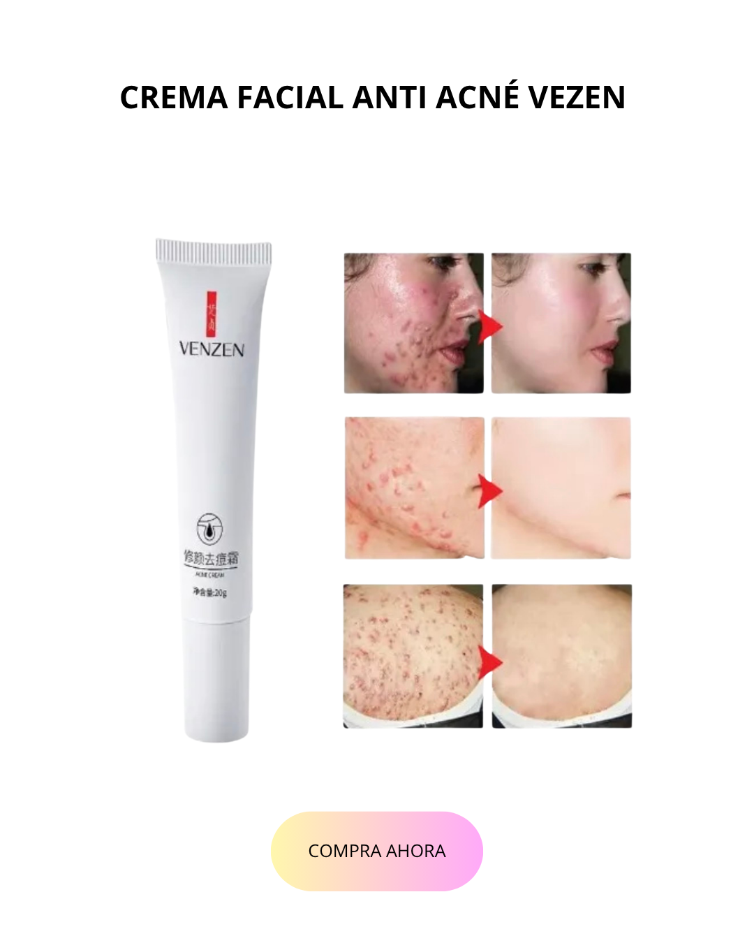 CREMA FACIAL ANTI ACNÉ VEZEN
